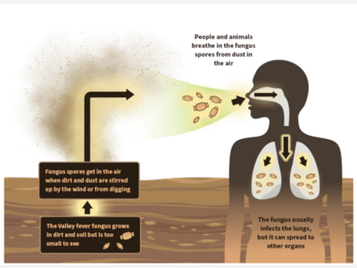 Valley Fever is on the Rise